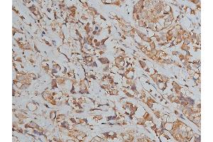 ABIN6267039 at 1/50 staining human breast cancer tissue sections by IHC-P. (Histone 3 anticorps)