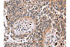 The image on the left is immunohistochemistry of paraffin-embedded Human lung cancer tissue using ABIN7129551(FUCA1 Antibody) at dilution 1/30, on the right is treated with fusion protein. (FUCA1 anticorps)