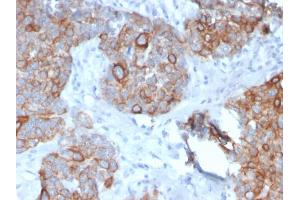 Formalin-fixed, paraffin-embedded human Prostate Carcinoma stained with STAT2 Mouse Monoclonal Antibody (STAT2/2650).