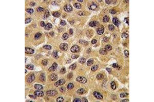 IHC analysis of FFPE human breast carcinoma tissue stained with CDC25B antibody