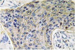Immunohistochemistry analysis of AQP4 Antibody in Paraffin-Embedded Human lung carcinoma tissue. (Aquaporin 4 anticorps)