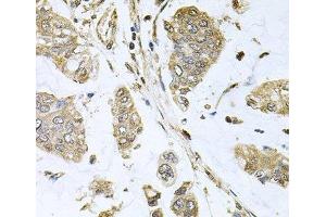 Immunohistochemistry of paraffin-embedded Human gastric cancer using SBDS Polyclonal Antibody at dilution of 1:100 (40x lens). (SBDS anticorps)