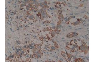 IHC-P analysis of Human Pancreatic cancer Tissue, with DAB staining.