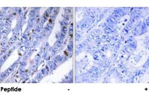 Immunohistochemical analysis of paraffin-embedded human colon carcinoma tissue using PRKAR2B polyclonal antibody . (PRKAR2B anticorps  (Ser113))