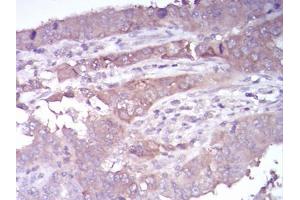Immunohistochemical analysis of paraffin-embedded endometrial cancer tissues using HDAC4 mouse mAb with DAB staining.