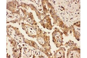 IHC-P: CXCR3 antibody testing of human lung cancer tissue (CXCR3 anticorps  (AA 1-368))