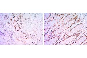 Immunohistochemical analysis of paraffin-embedded lung cancer tissues (left) and human rectum tissues (right) using KLF4 mouse mAb with DAB staining. (KLF4 anticorps  (AA 2-470))