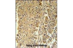 PGD Antibody (Center) (ABIN651639 and ABIN2840342) immunohistochemistry analysis in formalin fixed and paraffin embedded human lung carcinoma followed by peroxidase conjugation of the secondary antibody and DAB staining.