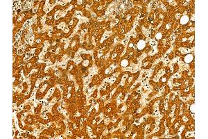 ABIN7094414 and ABIN7098461 at 1/100 staining Human pancreatic cancer by IHC-P. (OGDHL anticorps  (Internal Region))