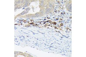 Immunohistochemistry of paraffin-embedded human colon carcinoma using von Willebrand factor (VWF) Rabbit pAb (ABIN3015449, ABIN3015450, ABIN5663874 and ABIN6217310) at dilution of 1:50 (40x lens). (VWF anticorps  (AA 50-150))