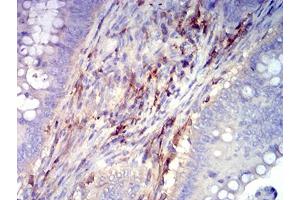 Immunohistochemical analysis of paraffin-embedded rectum cancer tissues using CD61 mouse mAb with DAB staining. (Integrin beta 3 anticorps  (AA 27-179))