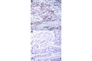 Immunohistochemical staining of human breast cancer tissue with NFKB2 (phospho S870) polyclonal antibody  without blocking peptide (A) or preincubated with blocking peptide (B) under 1:50-1:100 dilution. (NFKB2 anticorps  (pSer870))