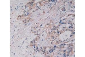 IHC-P analysis of Human Tissue, with DAB staining. (M-CSF/CSF1 anticorps  (AA 33-496))