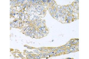 Immunohistochemistry of paraffin-embedded Human colon carcinoma using HDAC3 Polyclonal Antibody at dilution of 1:100 (40x lens). (HDAC3 anticorps)