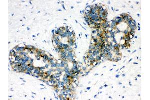 Anti-ARSA Picoband antibody,IHC(P) IHC(P): Human Mammary Cancer Tissue (Arylsulfatase A anticorps  (C-Term))