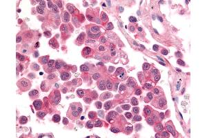 Anti-CDK12 / CRKRS antibody IHC of human Lung, Non-Small Cell Carcinoma.