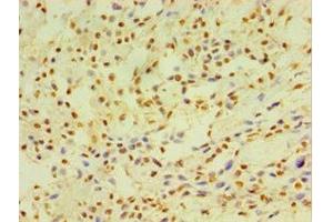 Immunohistochemistry of paraffin-embedded human breast cancer using ABIN7149254 at dilution of 1:100