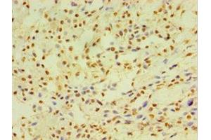 Immunohistochemistry of paraffin-embedded human breast cancer using ABIN7149254 at dilution of 1:100 (CYP2J2 anticorps  (AA 328-502))