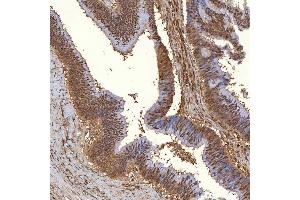 IHC analysis of PIG3/TP53I3 using anti-PIG3/TP53I3 antibody (ABIN7599280). (TP53I3 anticorps  (AA 1-332))