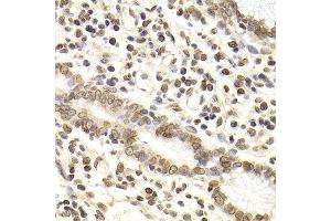 Immunohistochemistry of paraffin-embedded human gastric cancer using LMNB2 Antibody. (Lamin B2 anticorps  (AA 341-620))