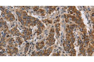 Immunohistochemistry of paraffin-embedded Human liver cancer using KCNQ4 Polyclonal Antibody at dilution of 1:40
