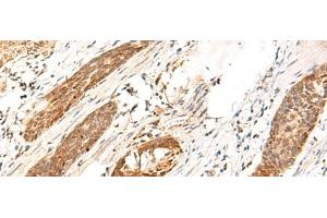 Immunohistochemistry of paraffin-embedded Human esophagus cancer tissue using DCAF10 Polyclonal Antibody at dilution of 1:130(x200) (DCAF10 anticorps)