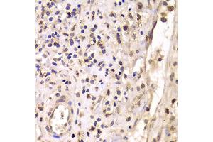 Immunohistochemistry of paraffin-embedded Human mammary cancer using HDAC4 antibody at dilution of 1:100 (x40 lens). (HDAC4 anticorps)