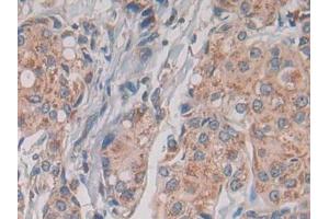 IHC-P analysis of Human Breast cancer Tissue, with DAB staining. (TLR1 anticorps  (AA 114-339))