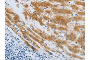 The image on the left is immunohistochemistry of paraffin-embedded Human liver cancer tissue using ABIN7190248(CHRFAM7A Antibody) at dilution 1/40, on the right is treated with synthetic peptide. (CHRNA7 anticorps)