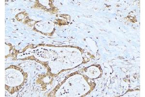 ABIN6275280 at 1/100 staining Human lung cancer tissue by IHC-P.
