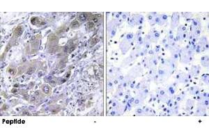 Immunohistochemistry analysis of paraffin-embedded human liver carcinoma tissue using MRPS18A polyclonal antibody .