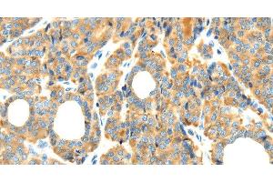 Immunohistochemistry of paraffin-embedded Human thyroid cancer tissue using RIPK4 Polyclonal Antibody at dilution 1:40 (RIPK4 anticorps)
