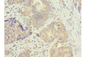 Immunohistochemistry of paraffin-embedded human gastric cancer using ABIN7165819 at dilution of 1:100