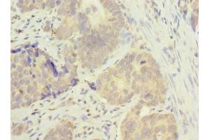 Immunohistochemistry of paraffin-embedded human gastric cancer using ABIN7165819 at dilution of 1:100 (MSTO1 anticorps  (AA 1-280))