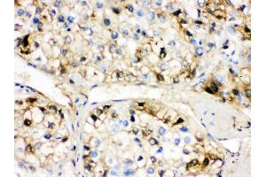 Anti- AHSG Picoband antibody, IHC(P) IHC(P): Human Liver Cancer Tissue