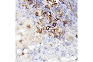 Immunohistochemistry of paraffin-embedded Human esophageal cancer using /IB antibody (527) at dilution of 1:50 (40x lens). (Iba1 anticorps  (AA 1-147))