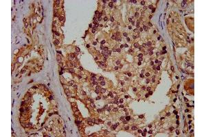 IHC image of ABIN7152156 diluted at 1:400 and staining in paraffin-embedded human prostate cancer performed on a Leica BondTM system.