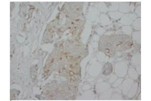 Immunohistochemical FLIPL antibody staining of Human Mammary Cancer Paraffin Sections. (FLIP anticorps  (C-Term, long form))