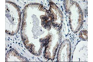 Immunohistochemical staining of paraffin-embedded Carcinoma of Human prostate tissue using anti-ERCC4 mouse monoclonal antibody. (ERCC4 anticorps)
