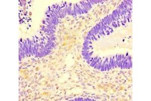 Immunohistochemistry of paraffin-embedded human ovarian cancer using ABIN7169732 at dilution of 1:100 (SMCO1 anticorps  (AA 82-214))