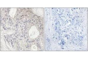 Immunohistochemistry analysis of paraffin-embedded human breast carcinoma tissue, using Cytochrome P450 1A2 Antibody. (CYP1A2 anticorps  (AA 331-380))