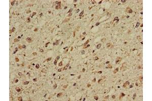 Immunohistochemistry of paraffin-embedded human glioma using ABIN7146829 at dilution of 1:100 (CPT1C anticorps  (AA 699-803))