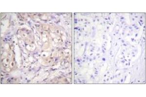 Immunohistochemistry analysis of paraffin-embedded human breast carcinoma, using B-RAF (Phospho-Thr599) Antibody. (SNRPE anticorps  (pThr599))