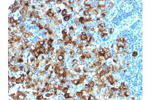 Formalin-fixed, paraffin-embedded human Melanoma stained with gp100 Rabbit Recombinant Monoclonal Antibody (PMEL/1825R). (Recombinant Melanoma gp100 anticorps)