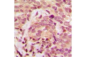 Immunohistochemical analysis of IKK gamma (pS31) staining in human breast cancer formalin fixed paraffin embedded tissue section.