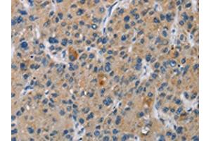 The image is immunohistochemistry of paraffin-embedded Human liver cancer tissue using ABIN7130969(SAR1B Antibody) at dilution 1/20.