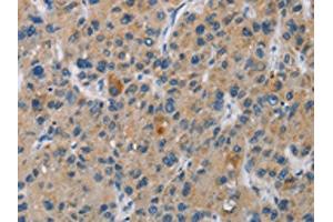 The image is immunohistochemistry of paraffin-embedded Human liver cancer tissue using ABIN7130969(SAR1B Antibody) at dilution 1/20. (SAR1B anticorps)