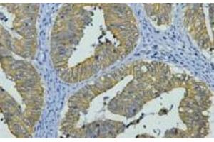 Immunohistochemistry of paraffin-embedded Human colon cancer tissue using CK-8 Monoclonal Antibody at dilution of 1:200. (KRT8 anticorps)
