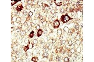 IHC analysis of FFPE human hepatocarcinoma tissue stained with the FGFR4 antibody (FGFR4 anticorps  (AA 24-55))