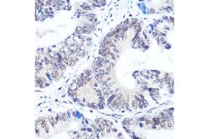 Immunohistochemistry of paraffin-embedded human colon carcinoma using SNRPB Rabbit pAb (ABIN6134519, ABIN6148214, ABIN6148215 and ABIN6219175) at dilution of 1:100 (40x lens).